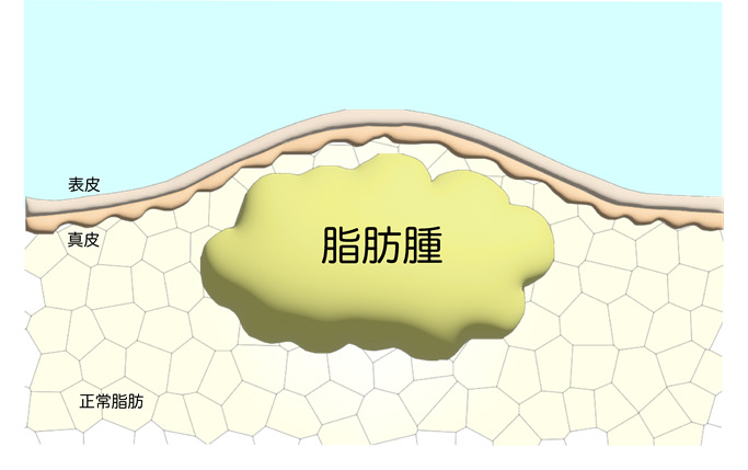 脂肪腫(リポーマ)のアイキャッチ画像