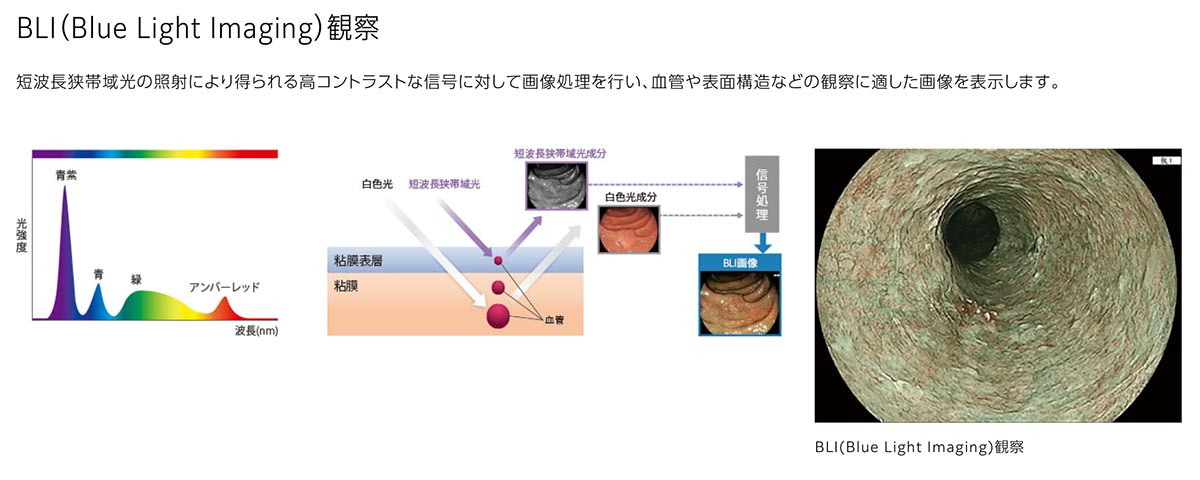 画像強調観察BLI/LCI機能