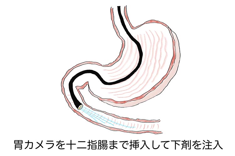 胃カメラ中に下剤注入