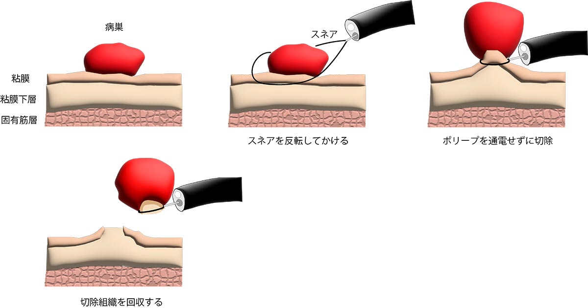 コールドポリペクトミー