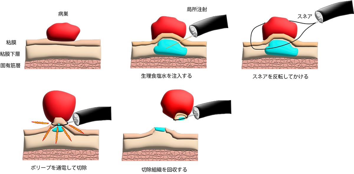 内視鏡的粘膜切除術